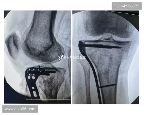 武磊膝微骨折手术欧洲名医主刀 武磊膝微骨折手术欧洲名医主刀